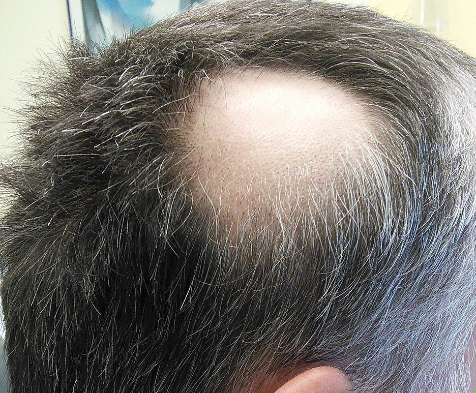 5 Different Hair Loss Treatments ArticleCube